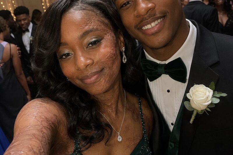 A Boy Asked Me to Dance at Prom Because No One Else Would Due to My Scars – The Next Day, His Parents and Officers Showed up at My Door